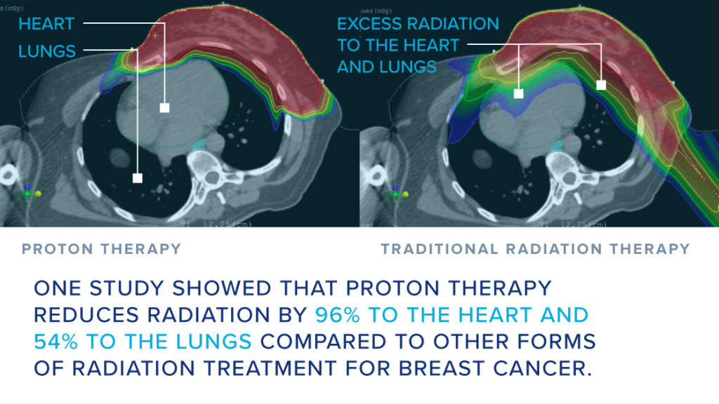 Breast-Graphic