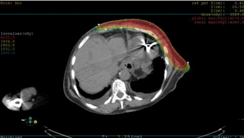 x-ray of breast cancer proton therapy