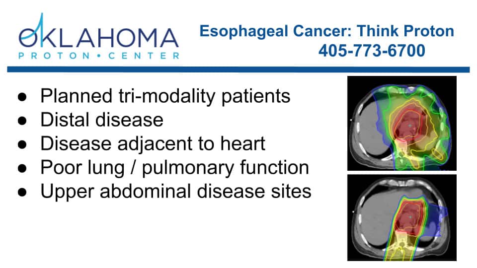 infographic about esophageal cancer: think proton