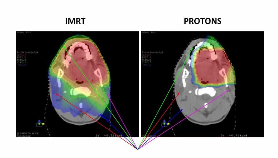 X-ray of radiation of IMRT and Protons