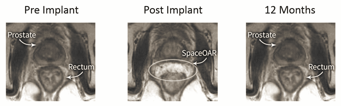 x-ray of prostate pre-implant, post implant, and 12 months