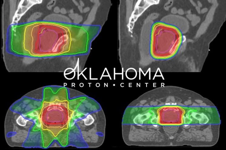 Radiation x-rays of prostates