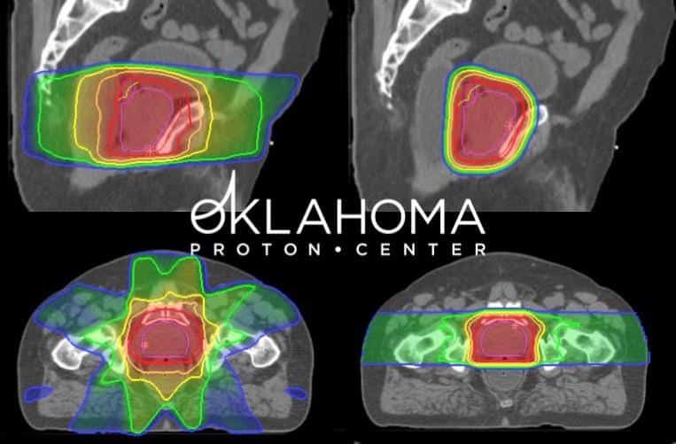 x-rays of prostate showing radiation