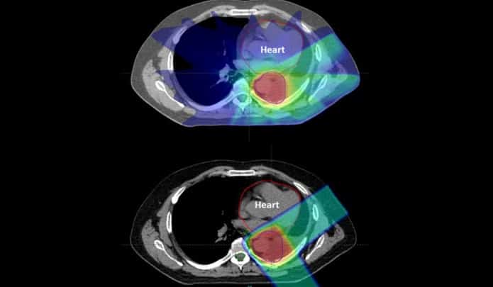 X-rays of hearts showing proton therapy