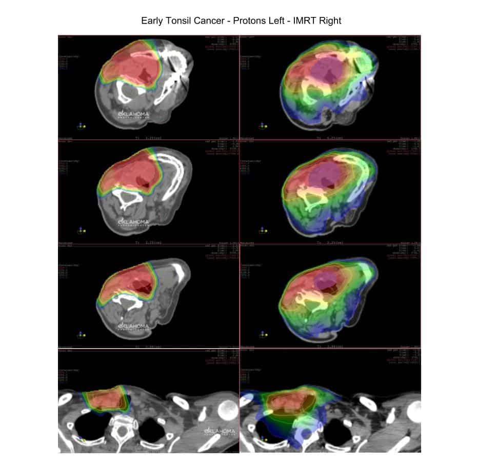 radiation x-ray photos of brains