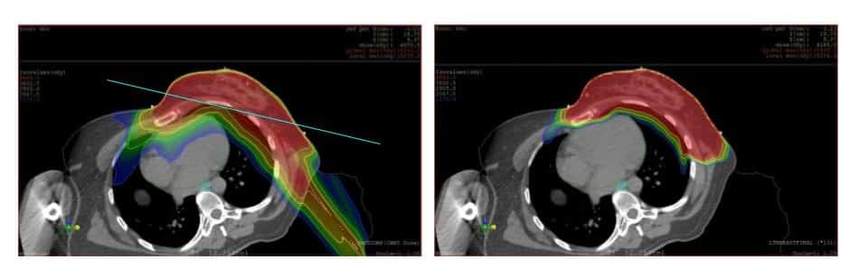 X-ray of where radiation dose goes in breast case