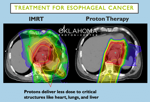 infographic of treatment for esophageal cancer